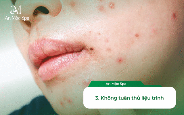 spa nặn mụn Hà Nội