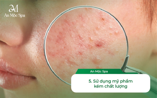 spa nặn mụn Hà Nội