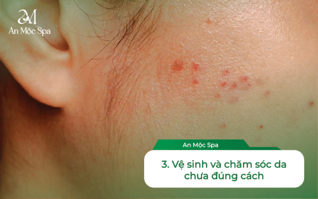 chăm sóc da mụn chuẩn y khoa