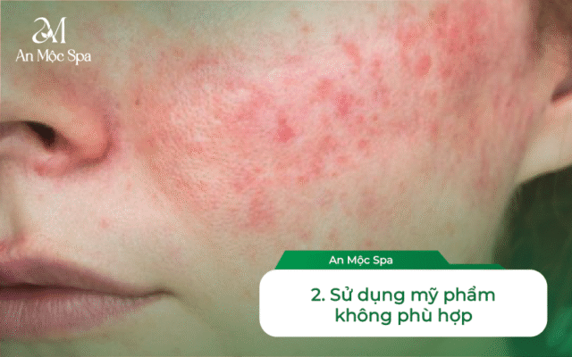 Spa nặn mụn uy tín Hà Nội