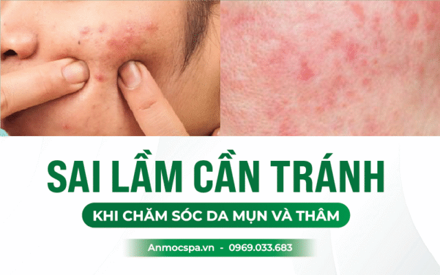 chăm sóc da mụn chuẩn y khoa