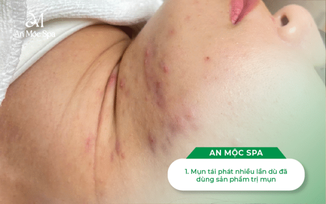 nặn-mụn-cầu-giấy