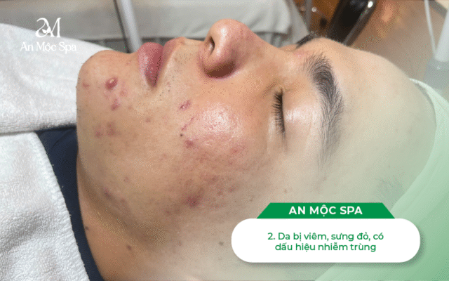 nặn-mụn-cầu-giấy