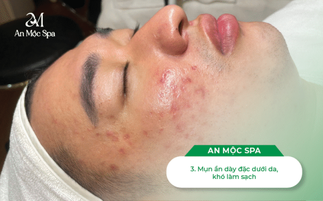 nặn-mụn-cầu-giấy