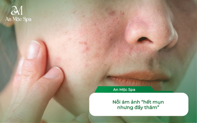 nặn mụn không để lại thâm