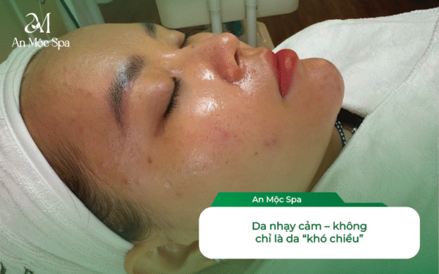 lấy nhân mụn cho da nhạy cảm