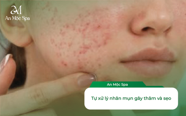 lấy nhân mụn cho dân văn phòng