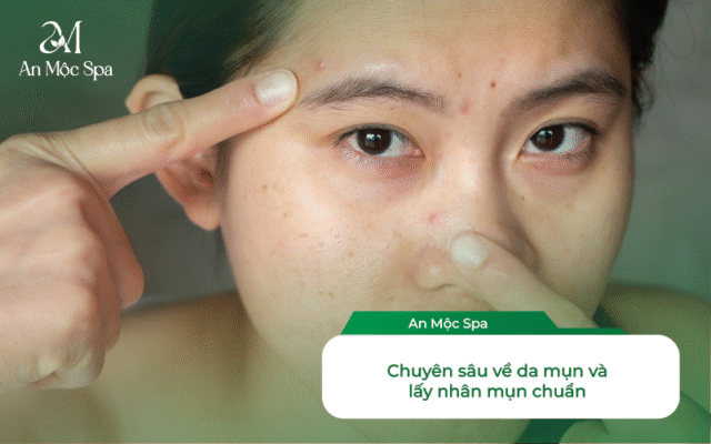 lấy nhân mụn cho dân văn phòng