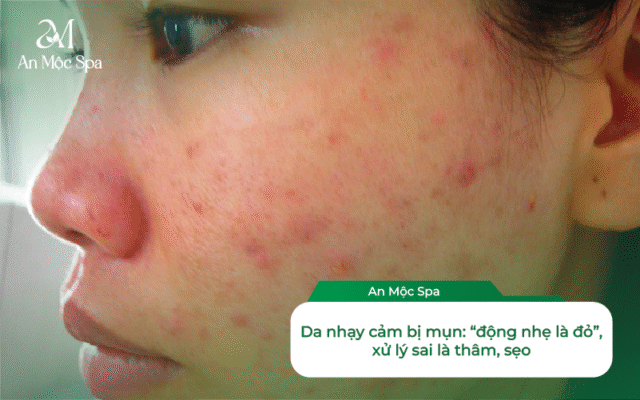 lấy nhân mụn cho da nhạy cảm