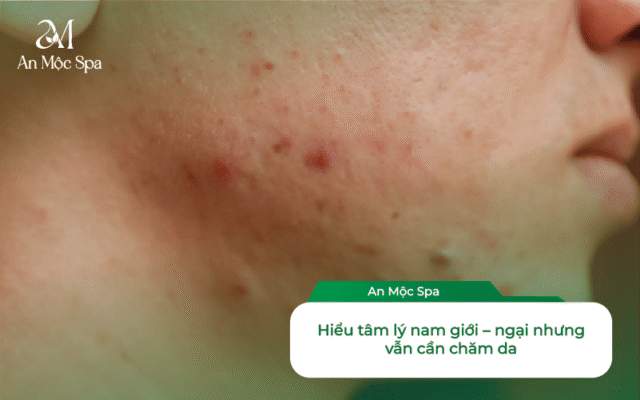 lấy nhân mụn cho nam giới