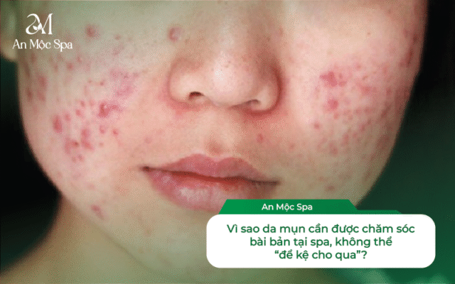 chăm sóc da mụn tại spa