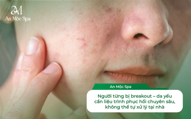 spa nặn mụn sinh viên uy tín Hà Nội