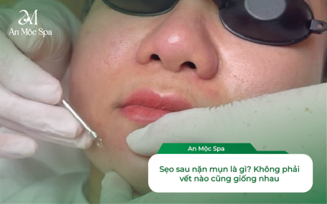 nặn mụn không để lại sẹo