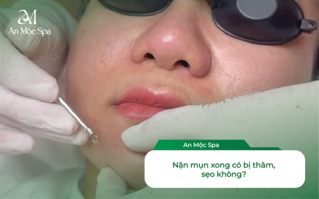 nặn mụn giá sinh viên