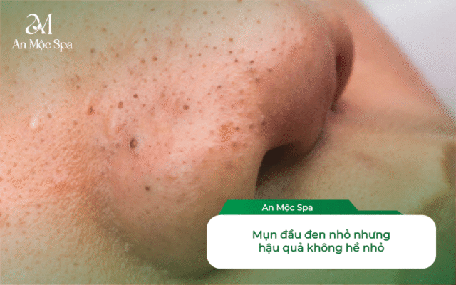 lấy nhân mụn chuyên sâu mụn đầu đen