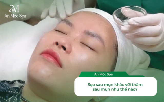 nặn mụn không để lại sẹo