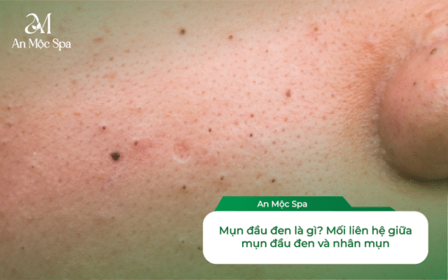 lấy nhân mụn chuyên sâu mụn đầu đen