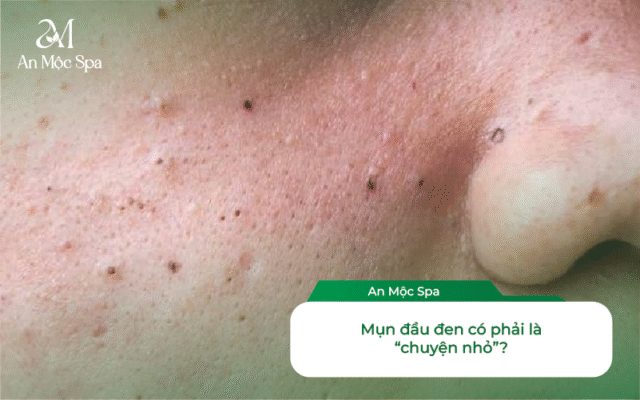 lấy nhân mụn chuyên sâu mụn đầu đen