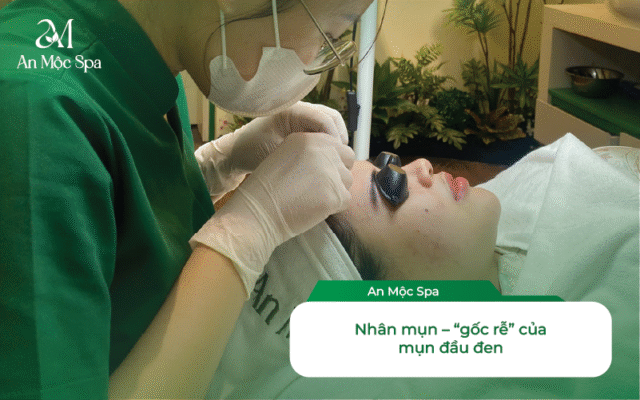 lấy nhân mụn chuyên sâu mụn đầu đen