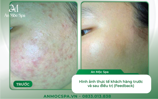 Spa nặn mụn Đống Đa