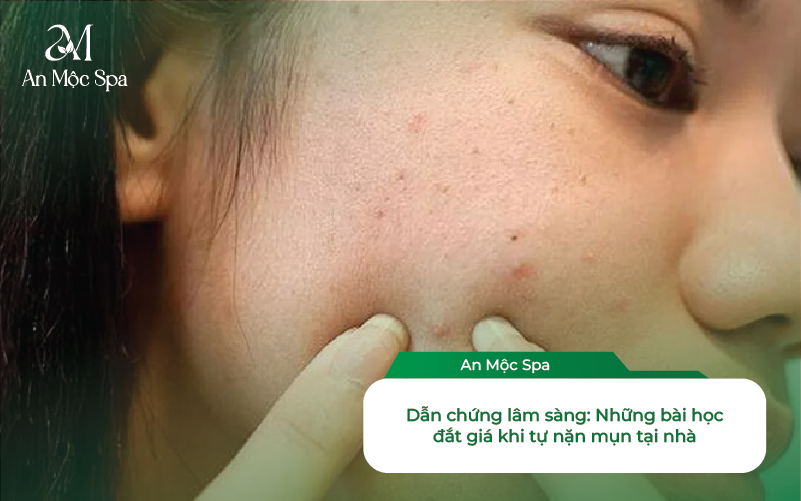 Nặn Mụn đinh Râu Bị Méo Mồm