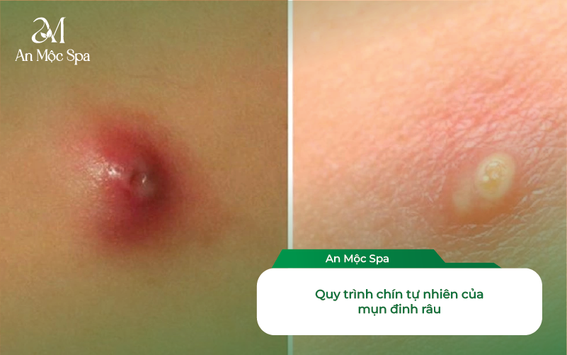 Nặn Mụn đinh Râu Bị Méo Mồm