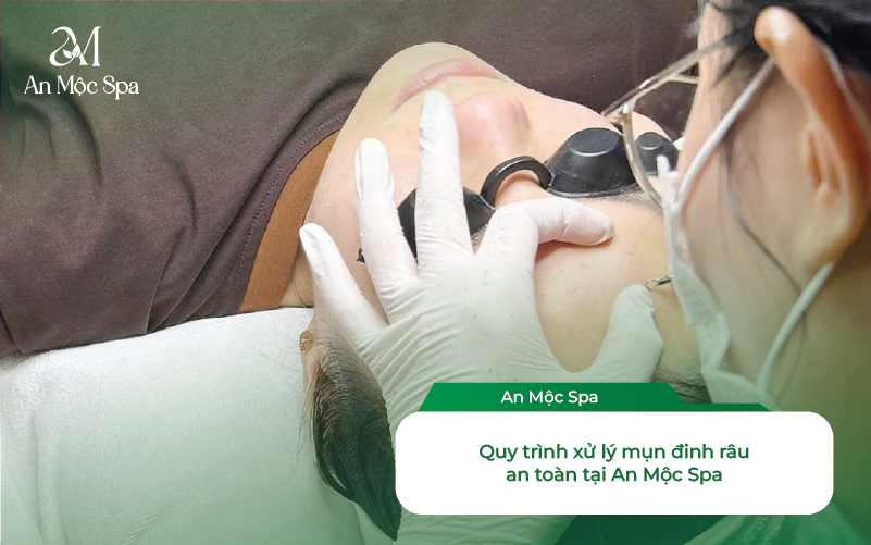 Nặn Mụn đinh Râu Bị Méo Mồm
