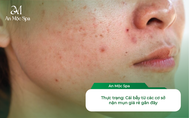 Spa Nặn Mụn Cầu Giấy