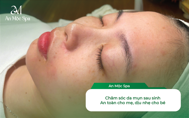 Chăm Sóc Da Mụn Dậy Thì