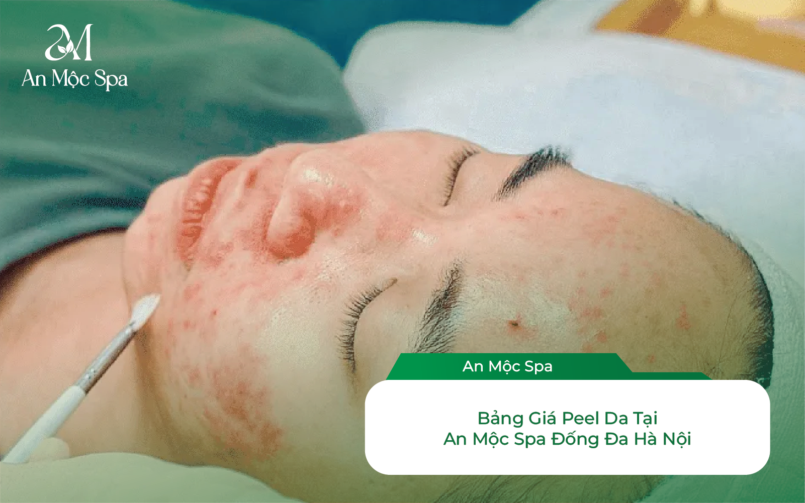 Bảng Giá Peel Da Đống Đa 