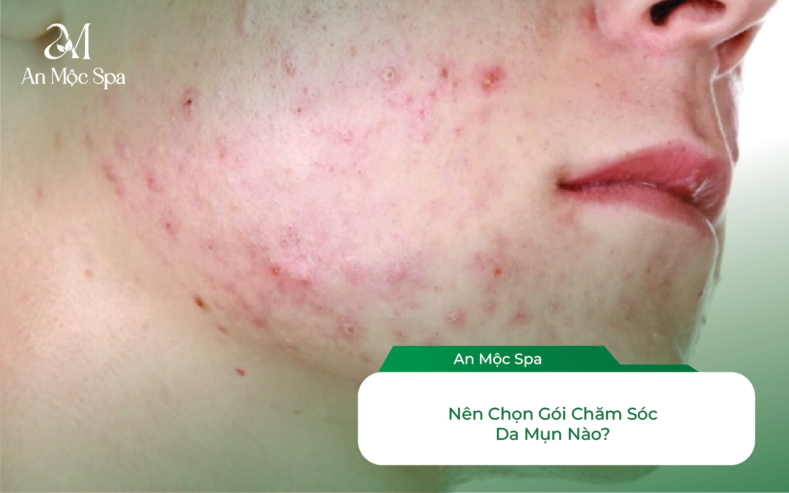 Nên chọn gói chăm sóc da mụn nào