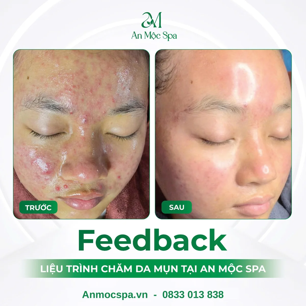 Hình ảnh trước và sau liệu trình chăm sóc da mụn nội tiết tại An Mộc Spa Đống Đa