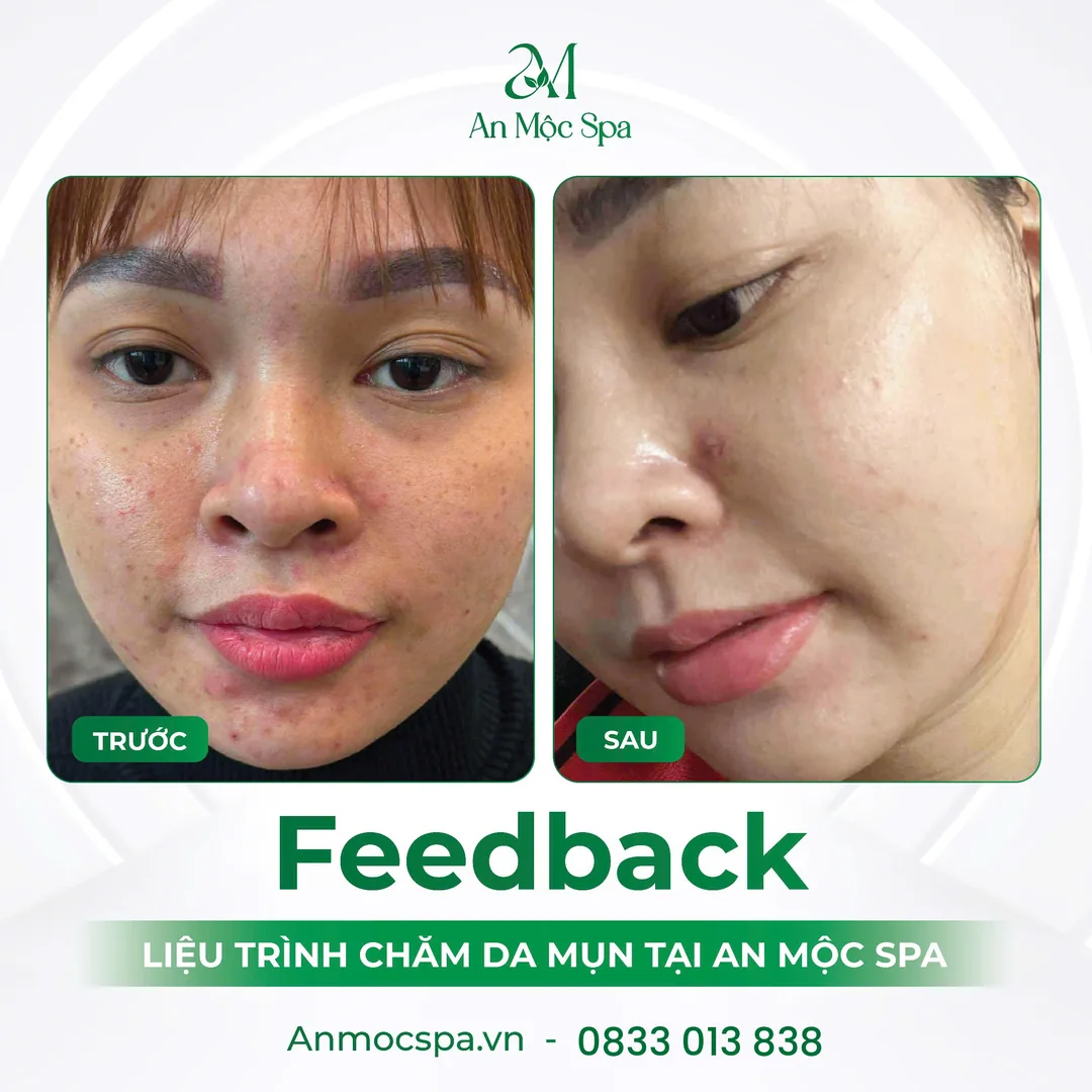 Hình ảnh trước và sau liệu trình chăm sóc da mụn tại An Mộc Spa Đống Đa