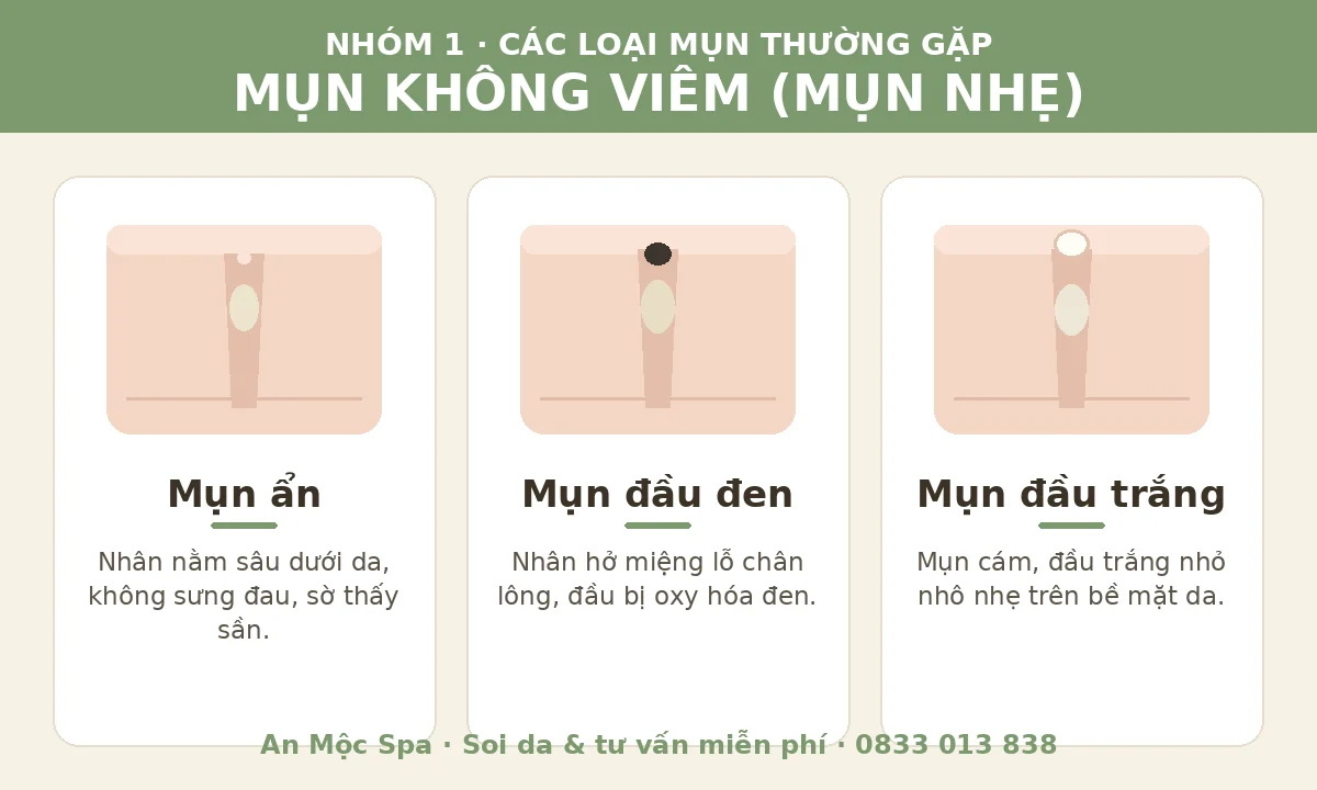 Minh họa các loại mụn thường gặp nhóm mụn không viêm gồm mụn ẩn, mụn đầu đen và mụn đầu trắng
